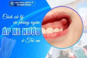 Áp xe nướu trẻ em