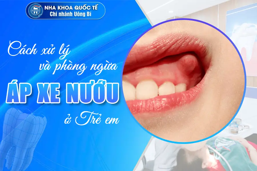 Áp xe nướu trẻ em