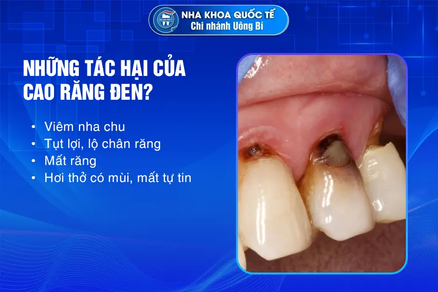 Tác hại cao răng đen 2
