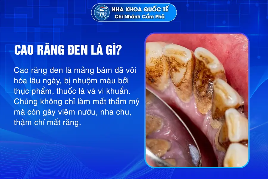 cao răng đen là gì