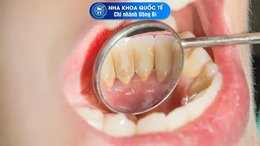 Cao răng nhiều có thể gây ra viêm lợi