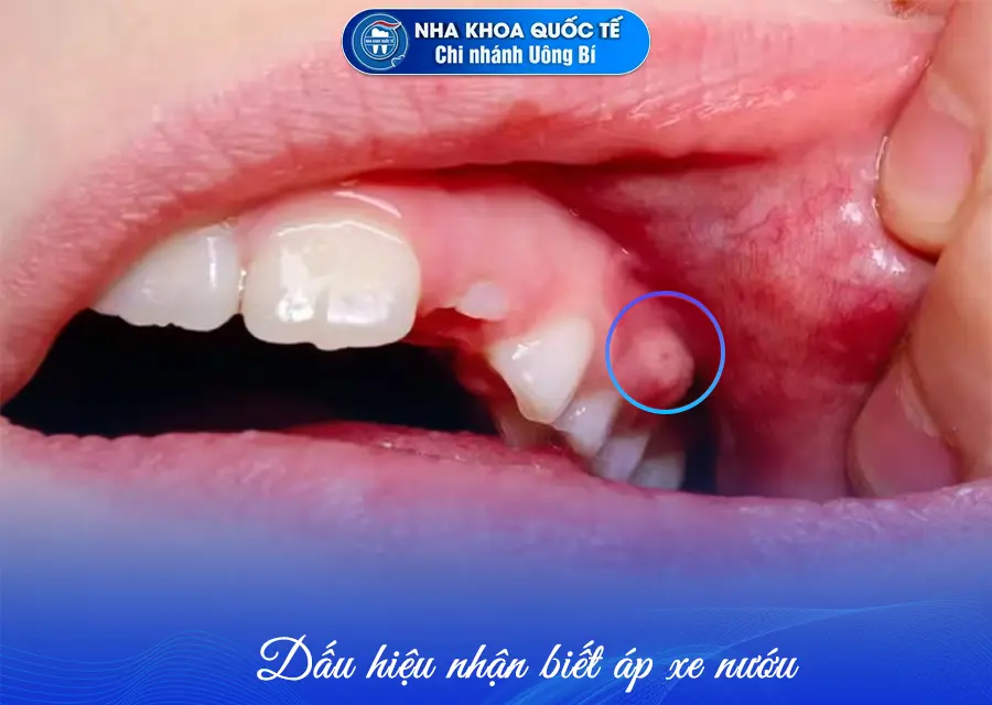 dấu hiệu Áp xe nướu trẻ em