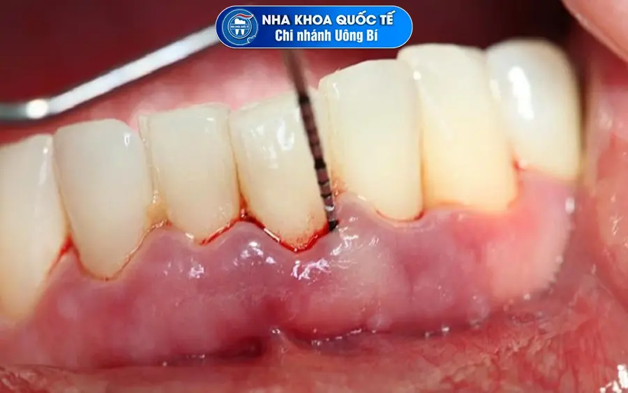 dấu hiệu viêm lợi