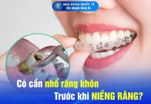 nhổ răng trước khi niềng