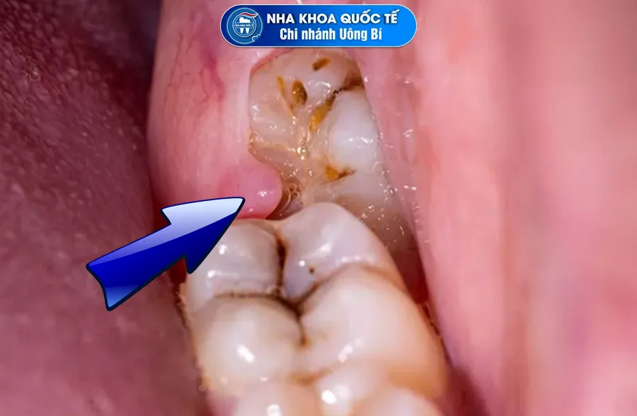 Không nhổ răng khôn trước khi niềng có thể gây viêm nhiễm, sâu răng