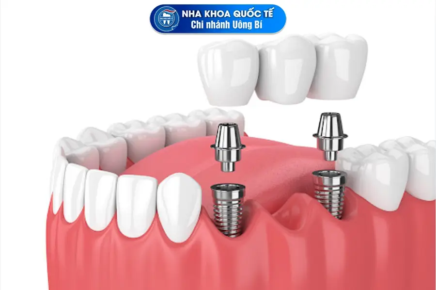 trồng implant răng hàm
