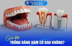 trồng răng hàm có đau không