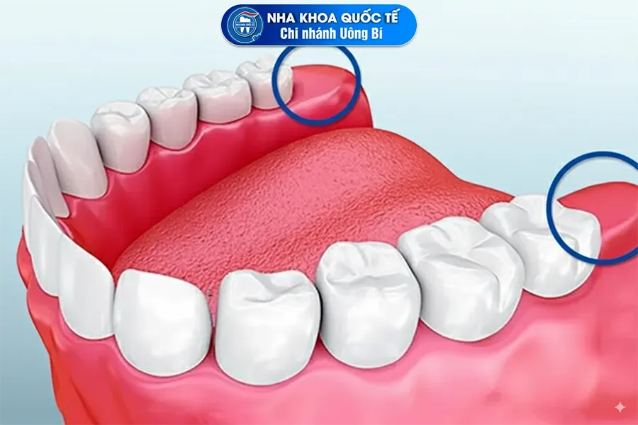 Nên nhổ răng khôn trước khi niềng nếu cần thiết