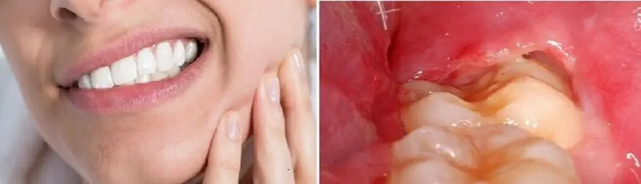 viêm lợi đau răng