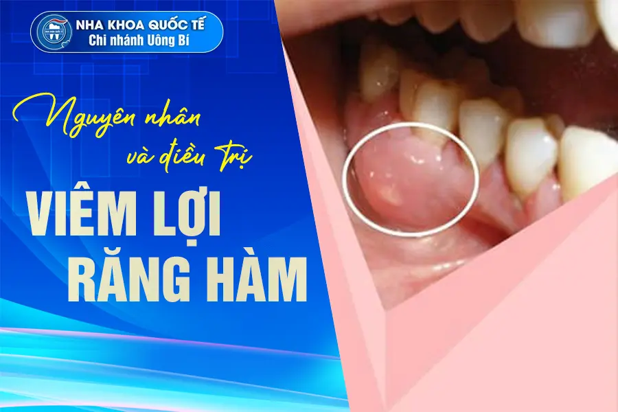 viêm lợi răng hàm