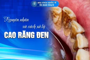 xử lý cao răng đen