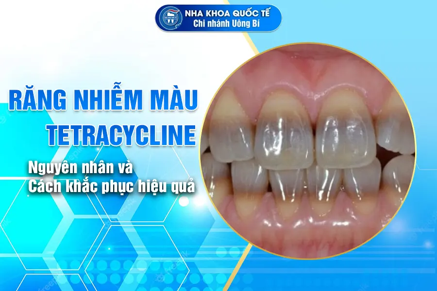 Răng nhiễm màu TETRACYCLINE