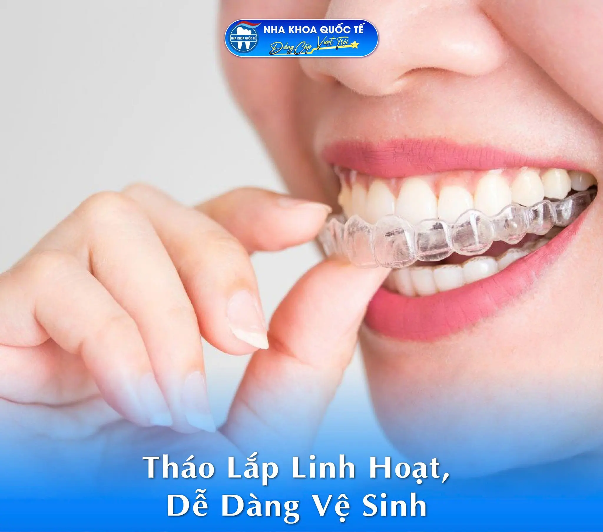 niềng răng trong suốt