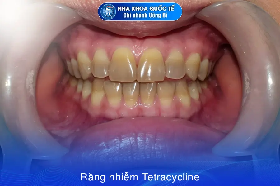 răng nhiễm Tetracycline
