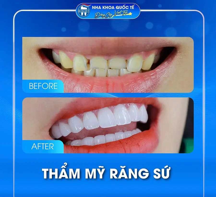 răng sứ thẩm mỹ 2