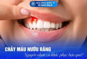 Chảy máu chân răng