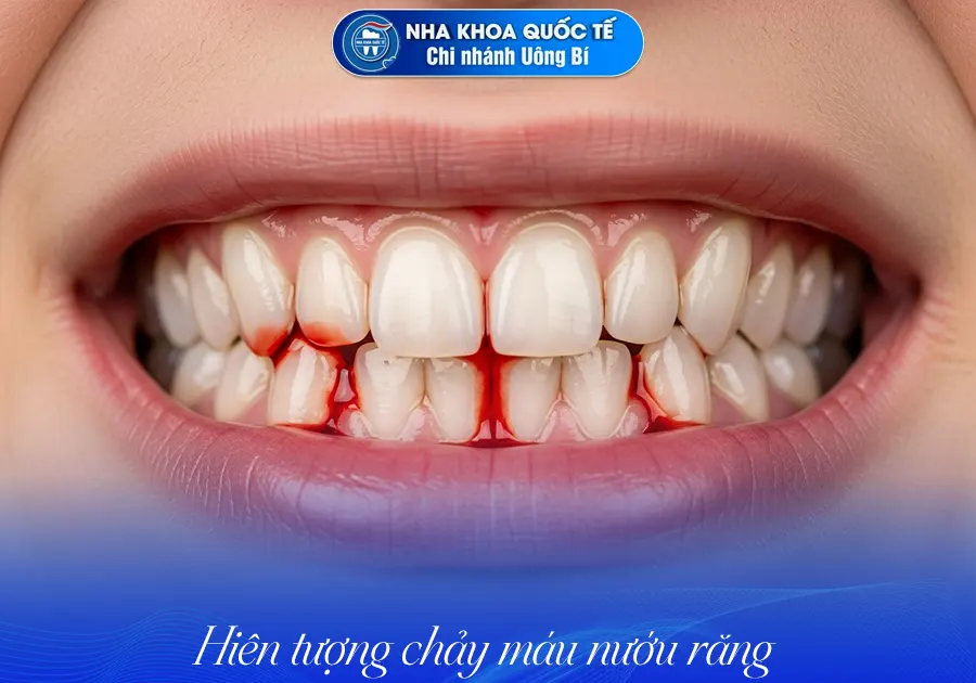 Chảy máu nướu răng