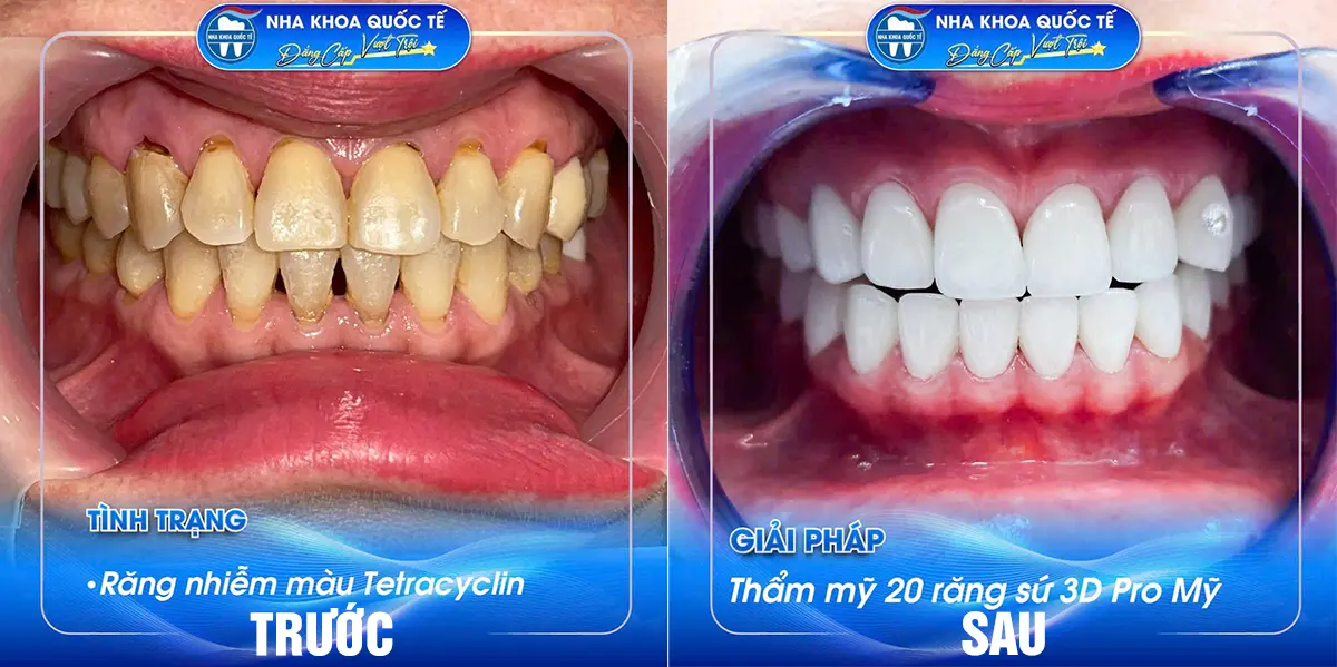 TRƯỚC VÀ SAU LÀM RĂNG SỨ