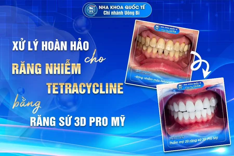 Xử lý răng nhiễm màu vàng