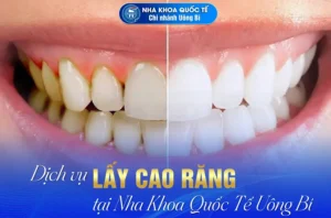 dịch vụ lấy cao răng uông bí