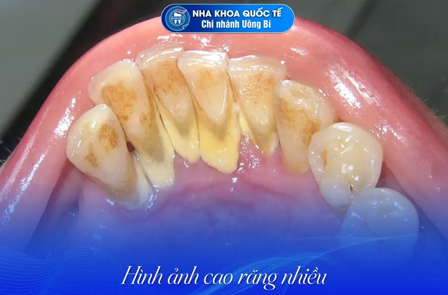 hình ảnh cao răng
