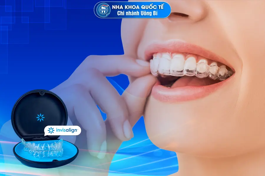 niềng invisalign 2