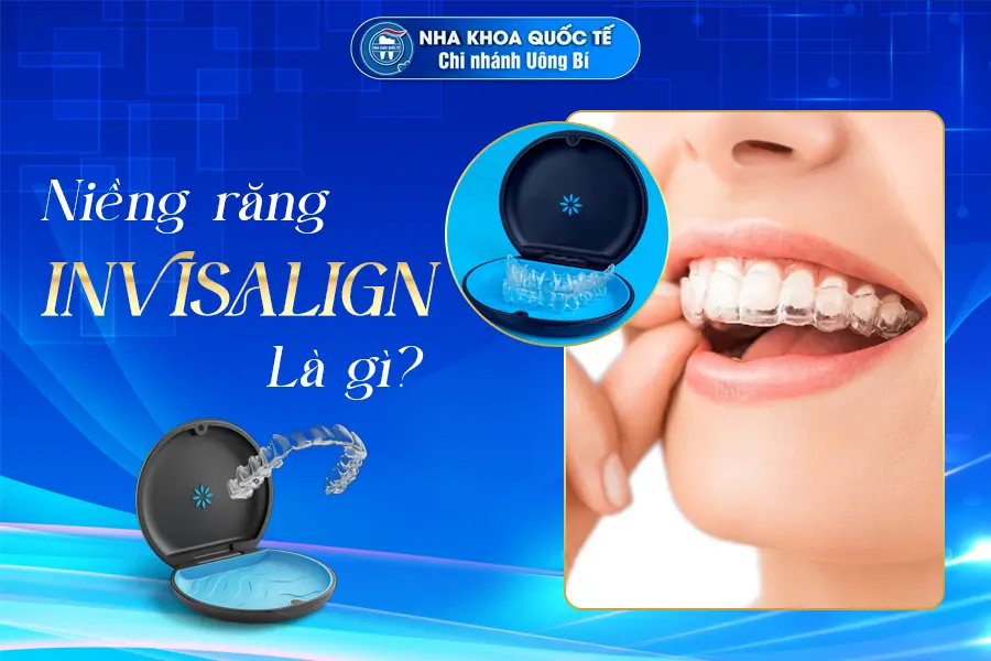niềng răng invisalign là gì