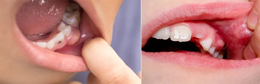 triệu chứng áp xe răng