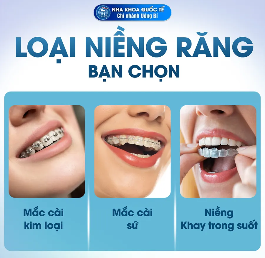 loại niềng răng