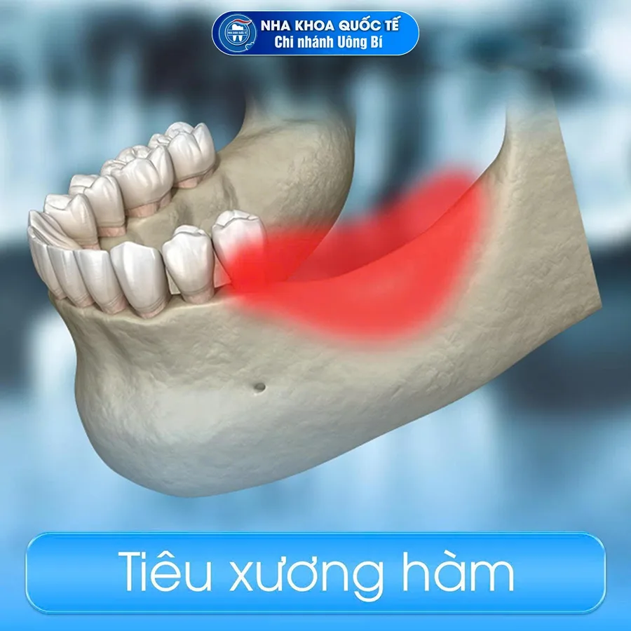 hiện tượng tiêu xương hàm