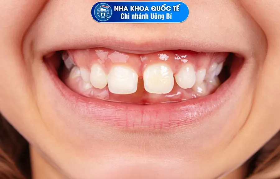 Răng thưa làm mất thẩm mỹ nụ cười