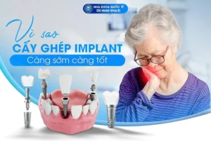 vì sao nên cấy ghép implant sớm