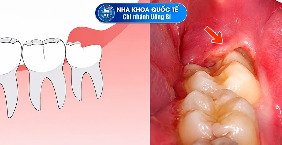 viêm lợi trùm răng khôn