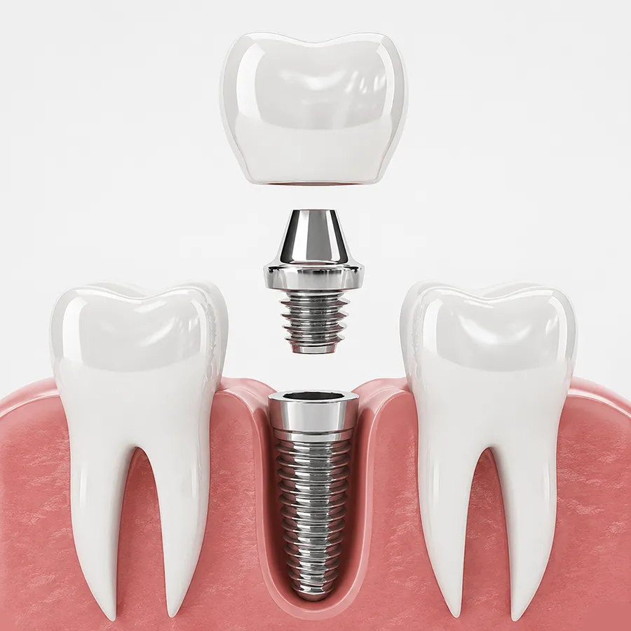 răng implant