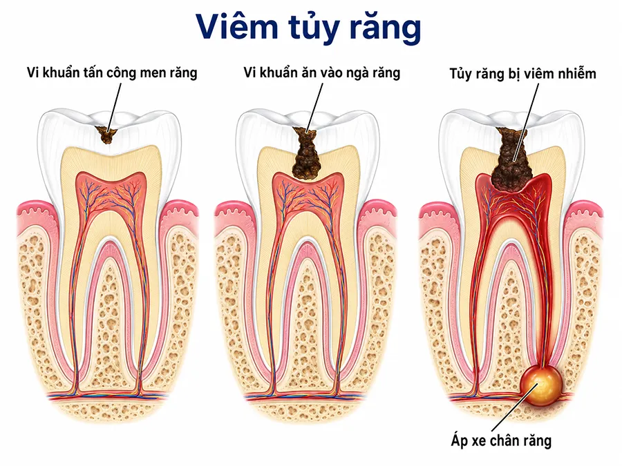 tình trạng viêm tủy