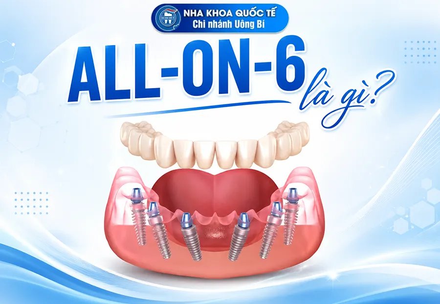 all on 6 là gì
