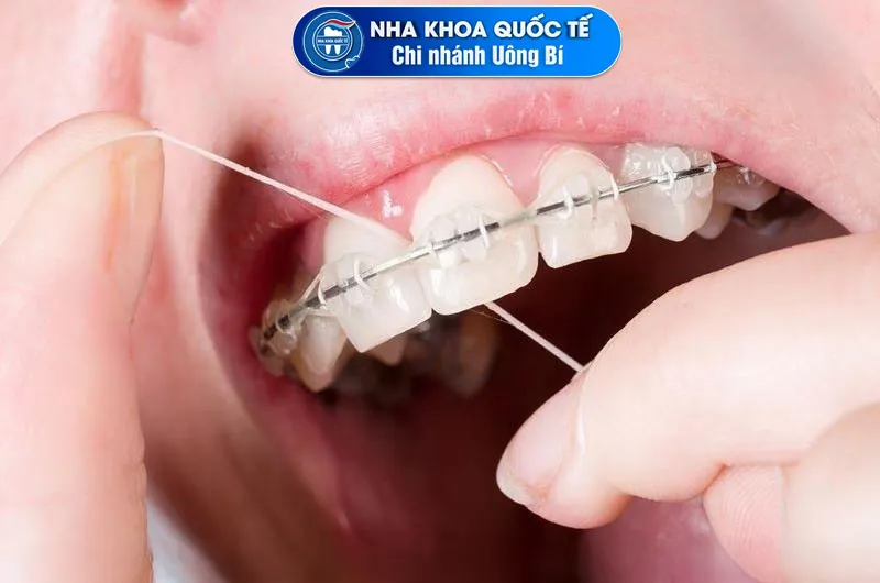 sử dụng chỉ nha khoa cho răng niềng