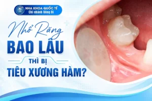 nhổ răng bao lâu thì bị tiêu xương