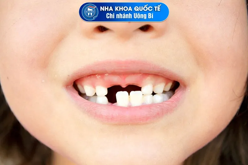 răng sữa rụng sớm