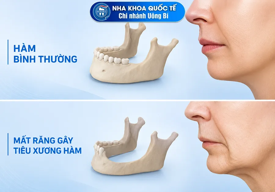 tiêu xương hàm do mất răng